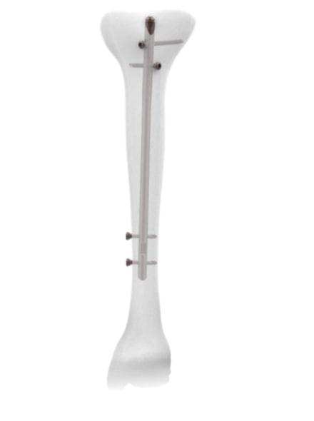 Auxein - JIN Тип – Гомілковий Стрижень